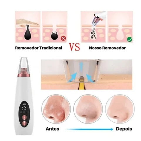 Máquina de Sucção Remove Cravos e Espinhas